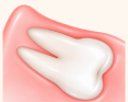 歯ぐきの中に埋まっているの図